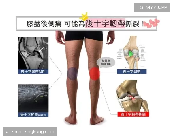前交叉韧带撕裂:听着像世界末日,其实是漫长康复的开始,前交叉韧带撕裂和断裂的区别 前交叉韧带撕裂:听着像世界末日,其实是漫长康复的开始,前交叉韧带撕裂和断裂的区别